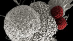 thérapie par les cellules T - cancer de l'ovaire