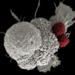 thérapie par les cellules T - cancer de l'ovaire